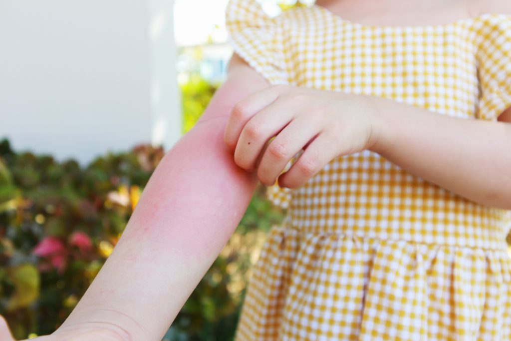 Child with mosquito bites